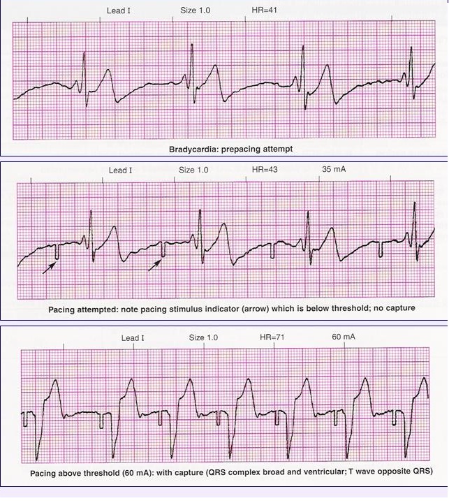 ACLS review Bradycardia part 5
