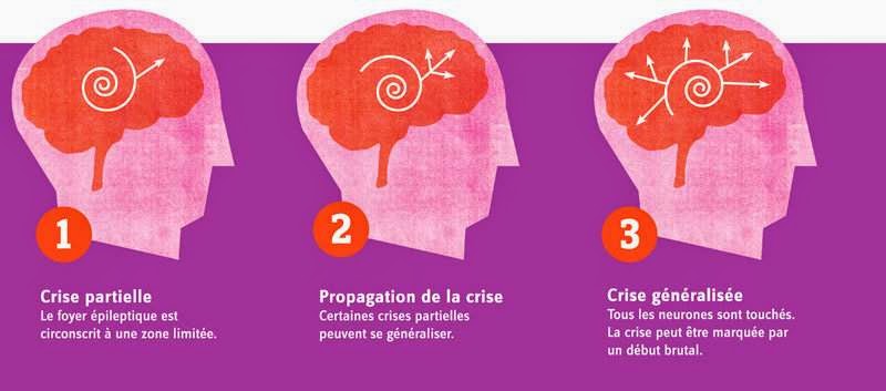 Récap' IDE: L'épilepsie