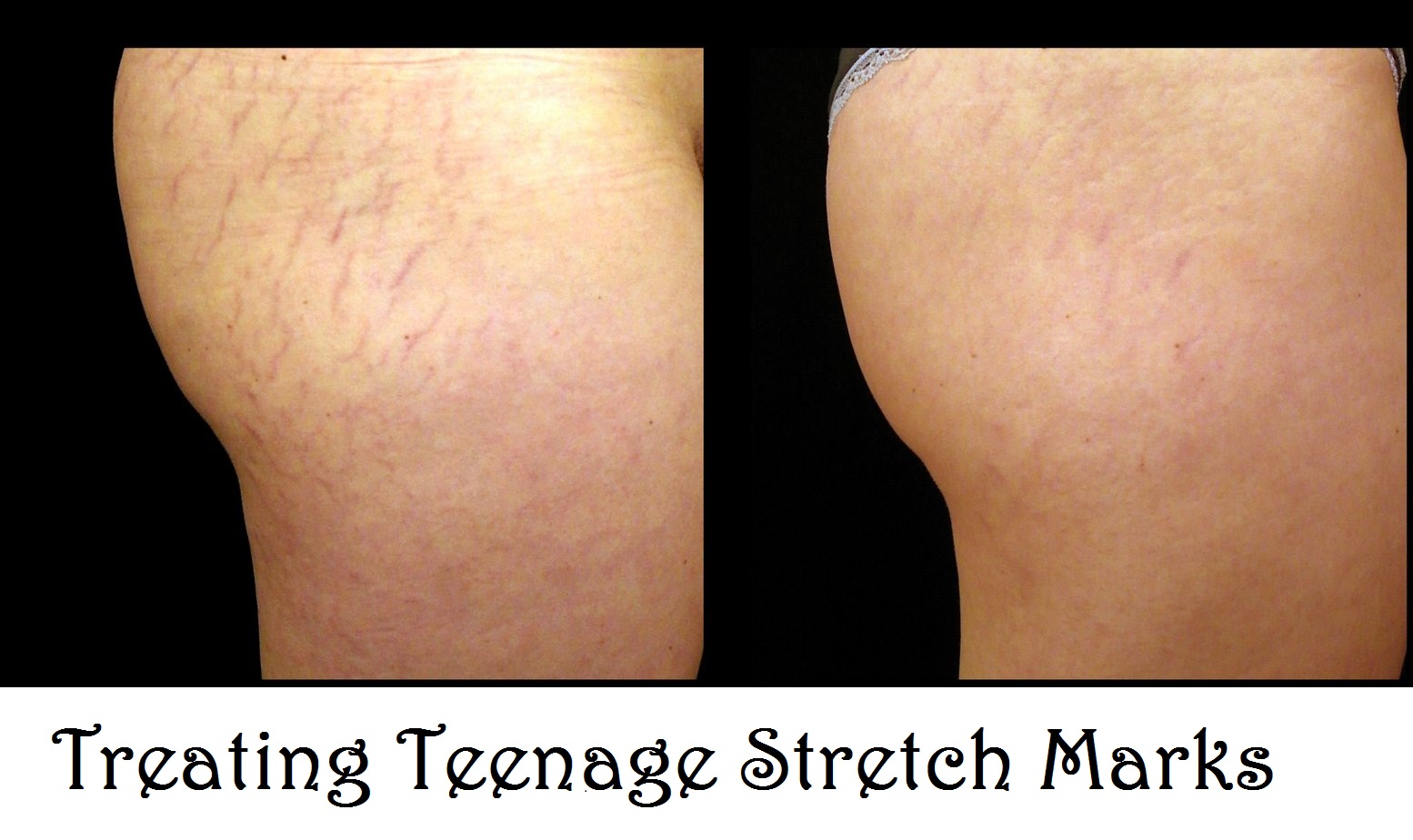 Treating Teenage Stretch Marks HEALTH TIPS 101