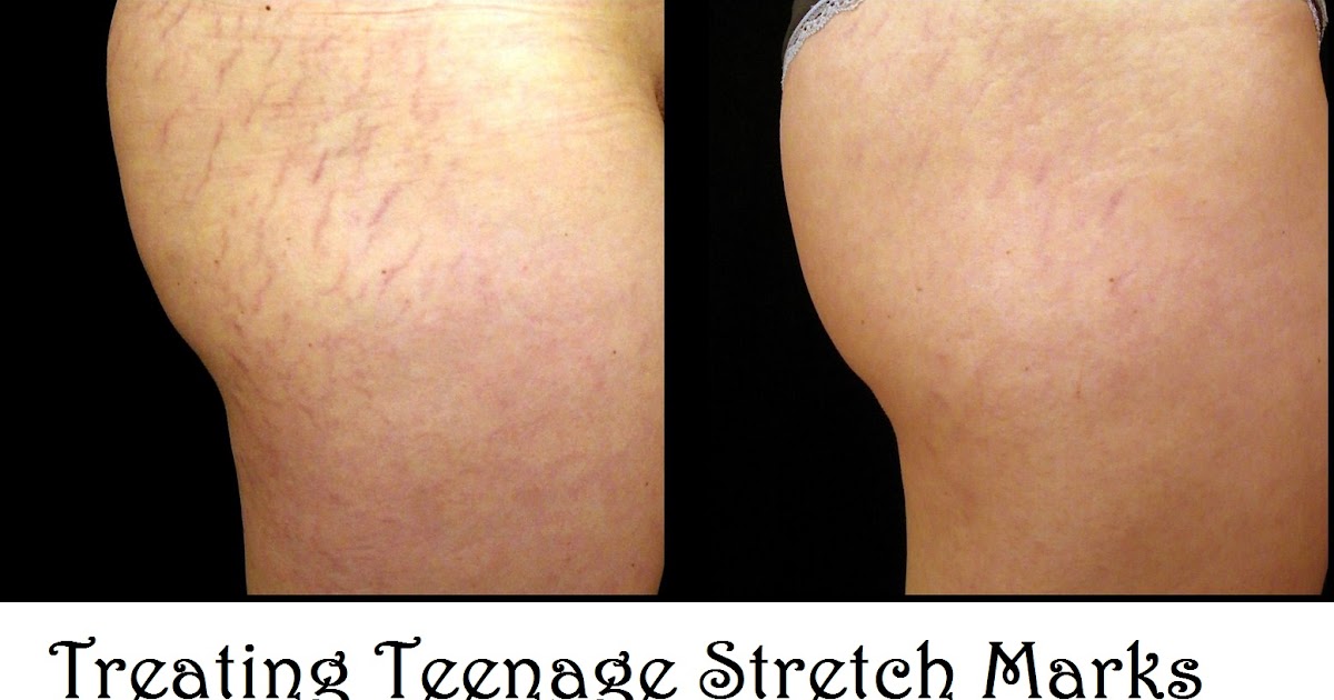 Treating Teenage Stretch Marks HEALTH TIPS 101