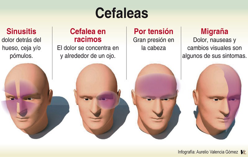 Tipos y ubicaciones de dolores de cabeza