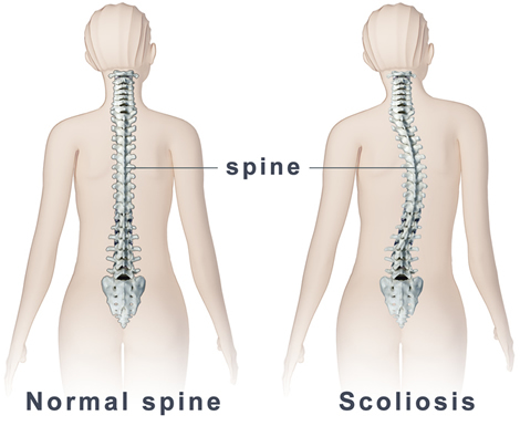Normal spine vs scoliosis
