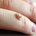 Treatment Of Warts Permanently With Home Remedies