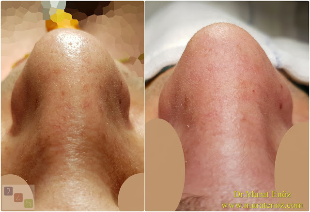 Burun estetiği ile birlikte septum perforasyonu kapatılması - Burun septumunda delik kapatılması - Burun septum perforasyonu ameliyatı - Erkek burun estetiği - Septum perforation closure in Istanbul - Septum perforation closure with under skin tissue - Closure of nasal septal perforations using under skin tissue - Combining rhinoplasty with septal perforation repair - Rhinoplasty in men Istanbul - Nose job in men Istanbul - Rhinoplasty in men Turkey - Erkek burun estetiği fotoğrafları - Burun estetiği Bakırköy Burun estetiği ile birlikte septum perforasyonu kapatılması - Burun septumunda delik kapatılması - Burun septum perforasyonu ameliyatı - Erkek burun estetiği - Septum perforation closure in Istanbul - Septum perforation closure with under skin tissue - Closure of nasal septal perforations using under skin tissue - Combining rhinoplasty with septal perforation repair - Rhinoplasty in men Istanbul - Nose job in men Istanbul - Rhinoplasty in men Turkey - Erkek burun estetiği fotoğrafları - Burun estetiği Bakırköy