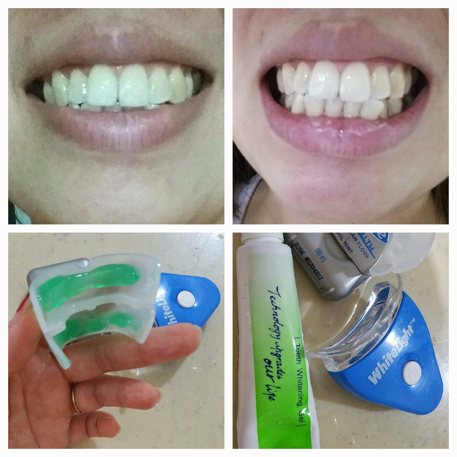 UGLYFATCHICK Review White Light Teeth Whitening Kit