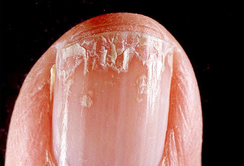 FlexiNail for Fingernail Growth. Turns Peeling, Brittle ...