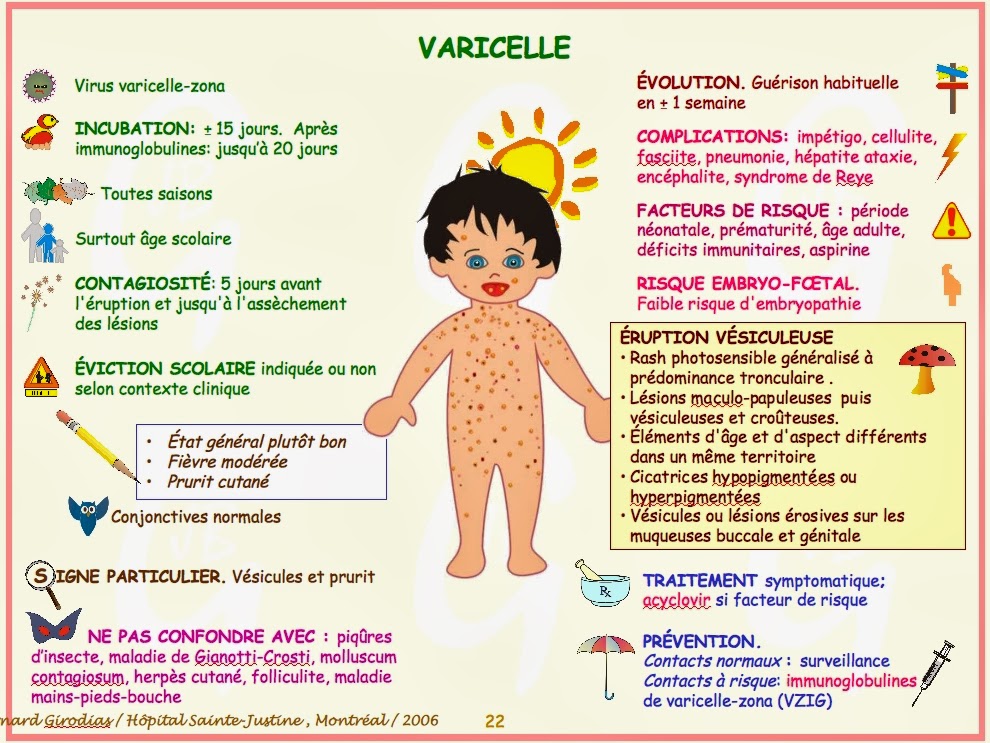 Blog 75 Infos santéVaricelle