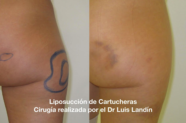 Liposucción cartucheras antes y después La imagen muestra el resultado de una liposucción de cartucheras. También se observan restos de hematoma típicos de una liposucción.