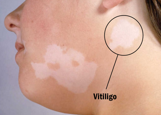 Obat Ampuh Menghilangkan Bercak Putih Vitiligo Obat Ampuh Menghilangkan Bercak Putih Vitiligo