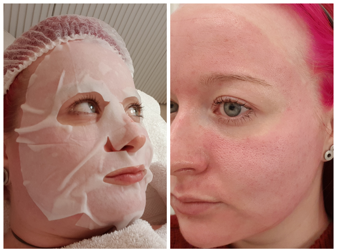 Microneedling & Me | Thérapie Clinic Before and after Microneedling & Me | Thérapie Clinic Before and after