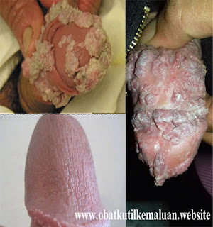 Obat Kutil Kelamin Di Bali Obat Kutil Kelamin Di Bali