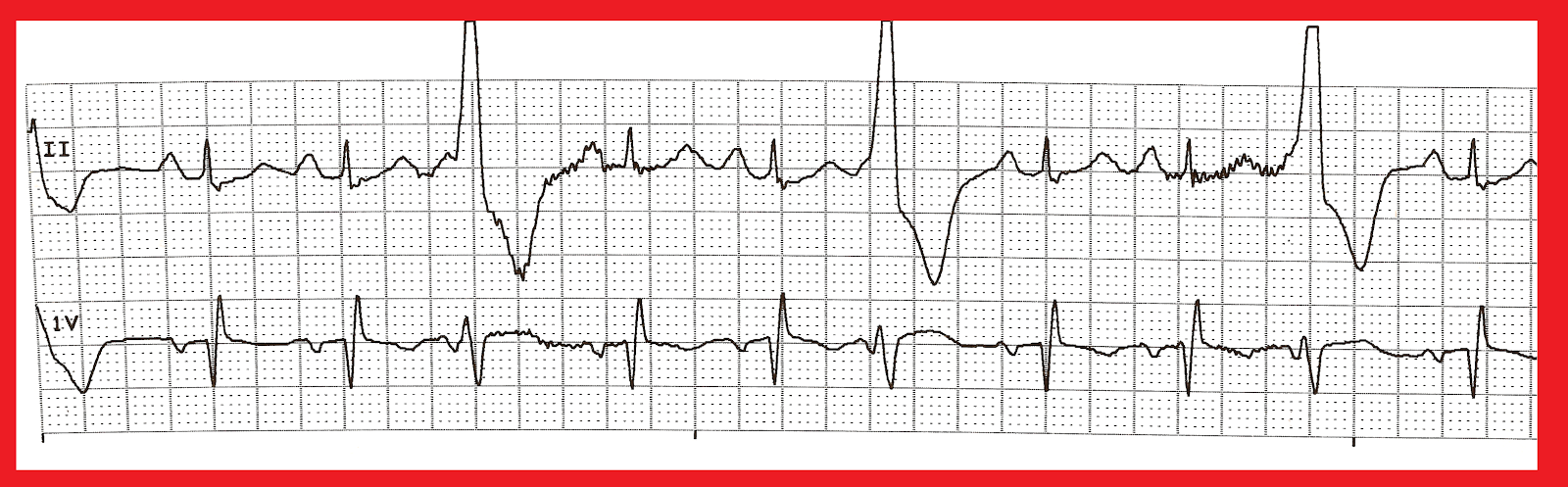 Practice EKG Strips 342