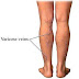 Natural Home Remedies for Varicose Veins (Varicose Veins cause & do or don't Tips)