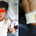 Lalaki Binenta Ang Kanyang Kidney 7 Years Ago Para Makabili Ng iPhone 4, Ngayon Ay Isa Na Syang Baldado
