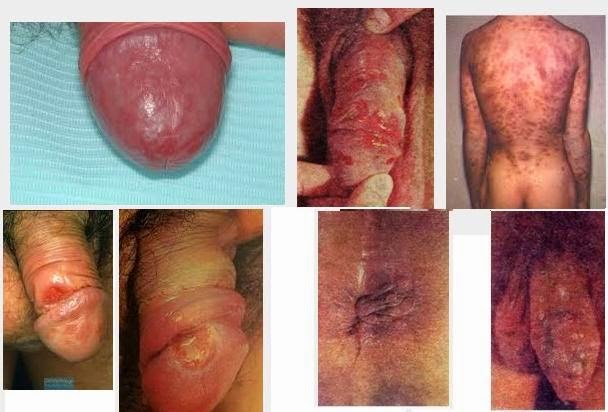 Obat Sipilis Herbal Dan Ampuh: Obat Herbal Untuk Mengobati Penyakit