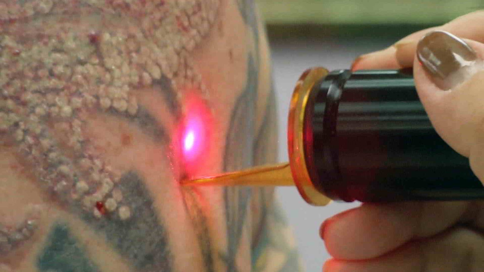 Laser borrando un tatuaje