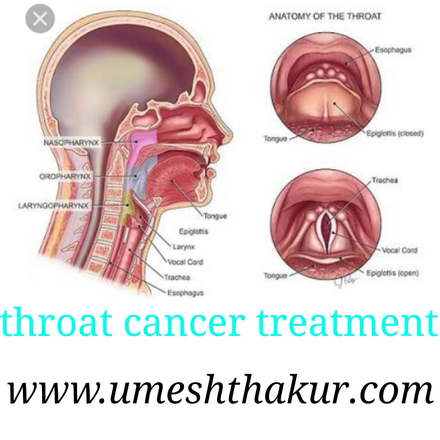 What is throat cancer in hindi recommend What is throat cancer in hindi forecast