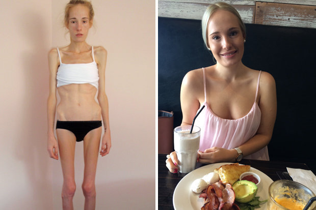 “Mai aveam 48h de trait” – o femeie anorexica isi revine in mod miraculos