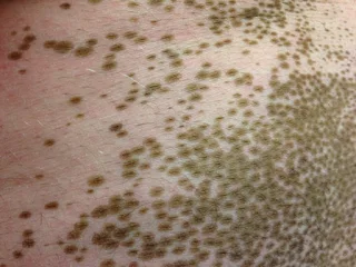 A medida que estos puntos marrones crecen y se fusionan, las manchas blancas del vitiligo desaparecen