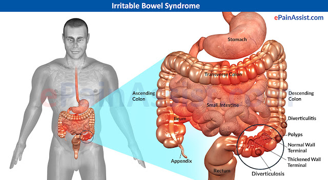 Resultado de imagen de Síndrome del intestino irritable