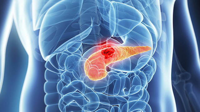 What Are The Symptoms Of Pancreatic Cancer What Causes Pancreatic Cancer - healtinews