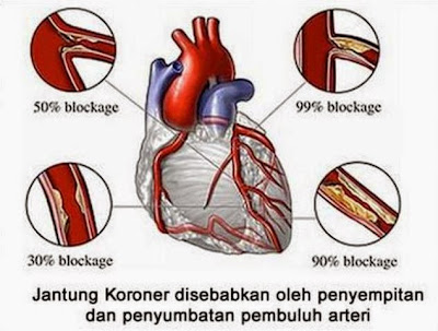 Terapi Non Farmakologi Penyakit Jantung Koroner Terapi Non Farmakologi Penyakit Jantung Koroner