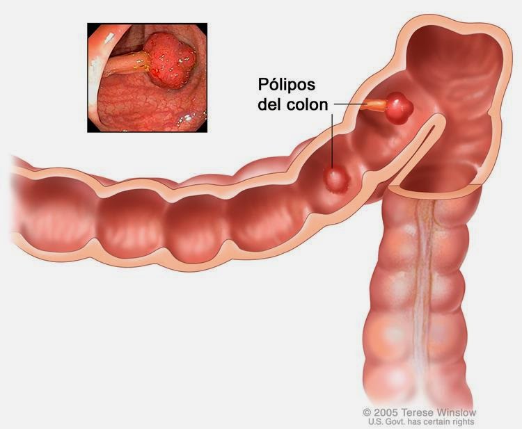 Que es un tumor en los intestinos