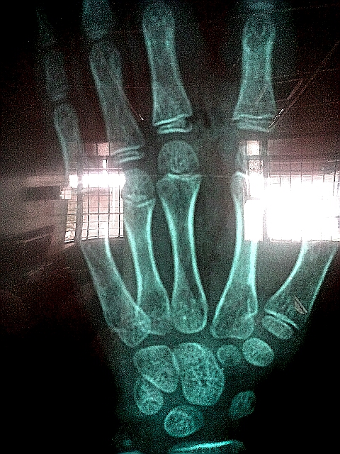 Rayos x de herida de mano