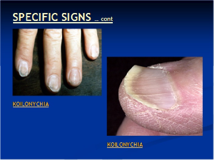 Iron Deficiency Anemia Nails