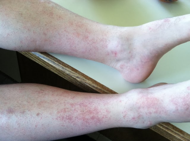 Rock and Roll Warrior: The rash and then some...