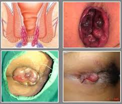 Image obat paling mujarab untuk hemoroid yang sudah parah