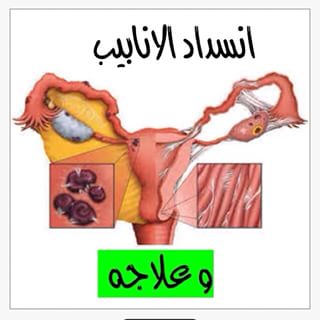 وصفات لفتح انسداد الانابيب عند النساء بالاعشاب To Open A Clogged Pipe For Women مجلة مغربيات