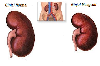 obat ginjal mengecil tradisional