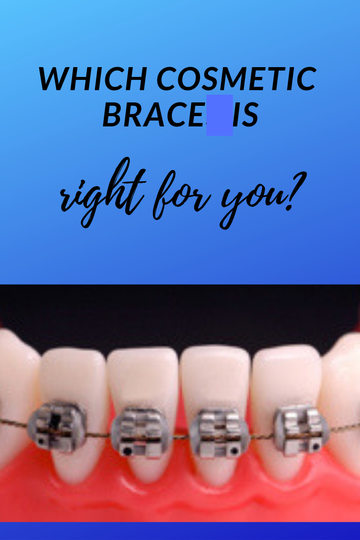 Which Cosmetic Brace is Right for You?