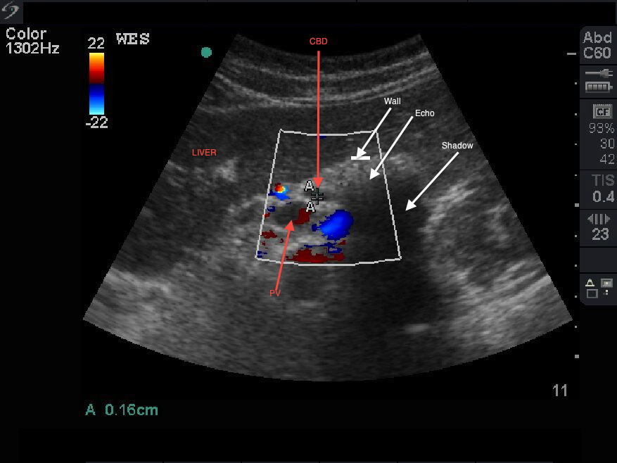 Porcelain Gallbladder Ultrasound Cases Info