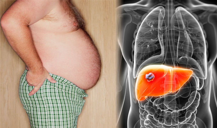 1 In 5 People Unknowingly Suffer From Human Fatty Liver Disease, Here's How To Heal Naturally