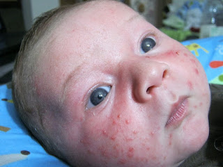 8 Things about Baby Pimples That You Must Understand 8 Things about Baby Pimples That You Must Understand