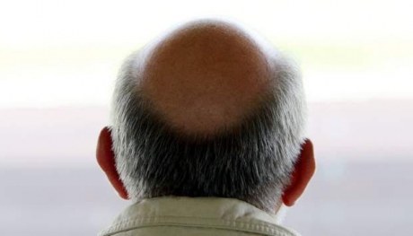 Dasanworld Men Women Why Bald Fall Some Tips To Grow Hair Back