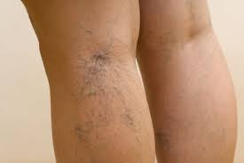 Anemie 9eme mois grossesse - Anemie 5 mois de grossesse