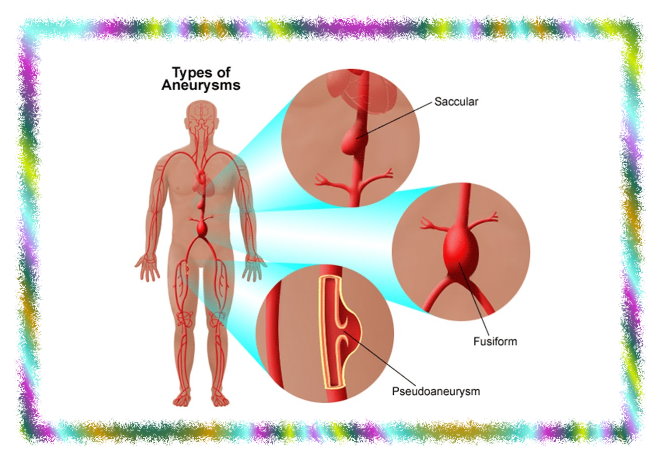 Aneurysm Sure Developers Team