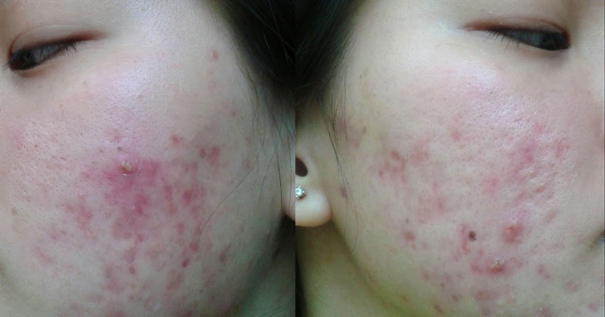 5 Error using acne medications can cause acne more and more Good info