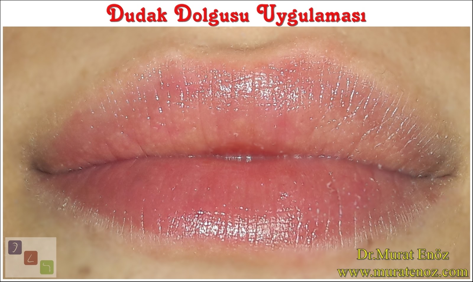guzel bir dudak dolgusu materyali regenyal idea lips