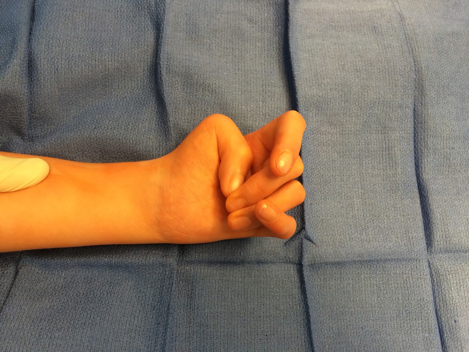 The Arthrogryposis Thumb Congenital Hand and Arm Differences