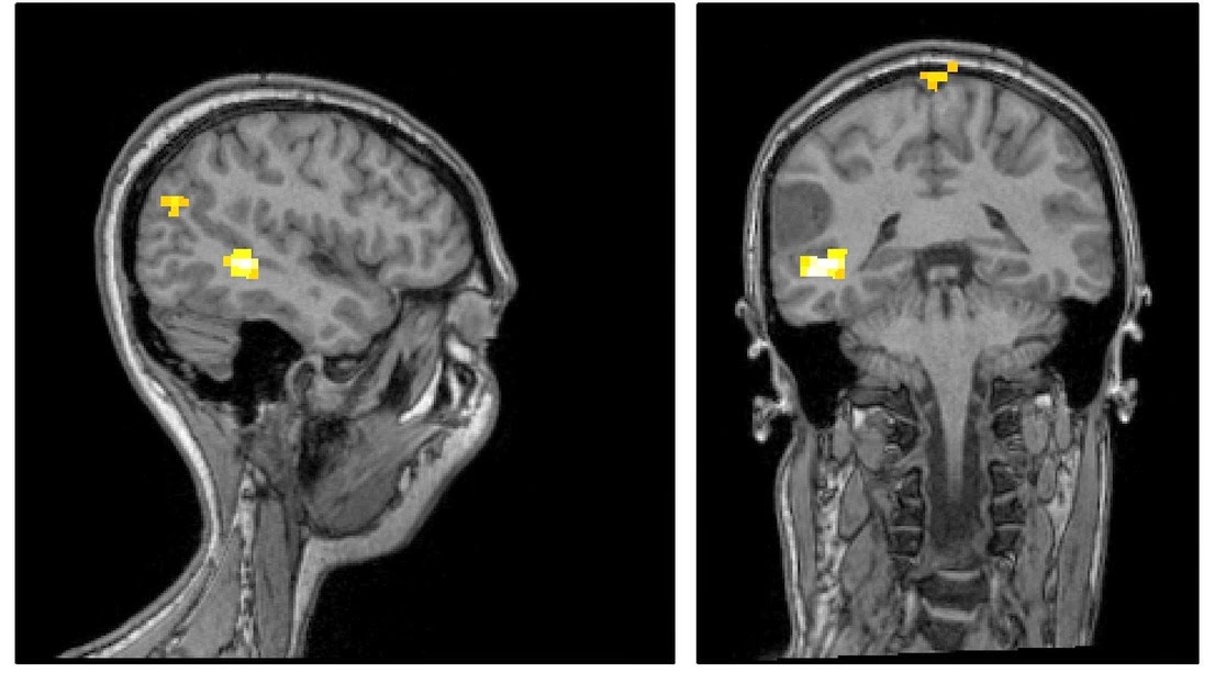 звуки мрт головного мозга. водянка головного мозга мрт. Mri головного мозга. мрт головного мозга тагил. 5 тесла высокопольный.