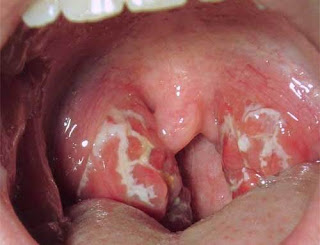abscess in mouth