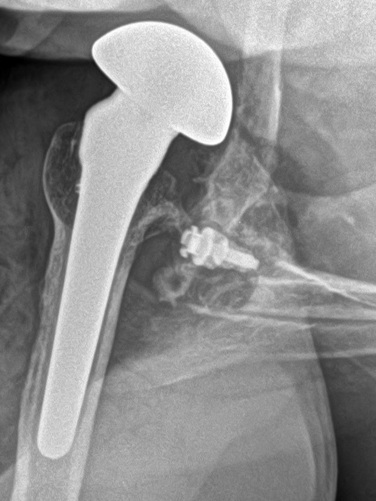 UW Shoulder and Elbow Academy Failure of anatomic total shoulder joint