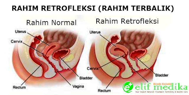 Rahim Retrofleksi, Terbalik, Miring dan Menekuk Kebelakang Rahim Retrofleksi, Terbalik, Miring dan Menekuk Kebelakang