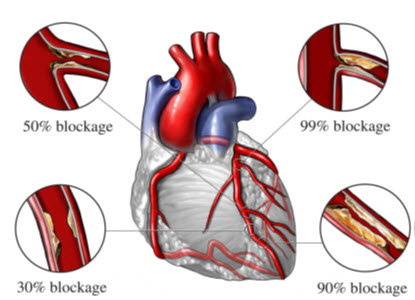 Classification of Coronary Artery diseases