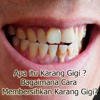 Pengertian Karang Gigi dan Cara Membersihkan Karang Gigi
