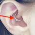 MIGRAINES: CAN A SPECIAL EAR PIERCING BE A MIGRAINE CURE?